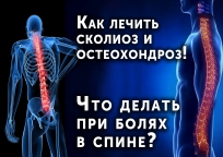   Що таке остеохондроз .  